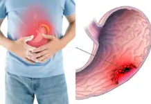 Stomach Cancer: Doctor Warns THIS One Untested Infection Could Be The Biggest Health Threat You’re Missing Stomach Cancer